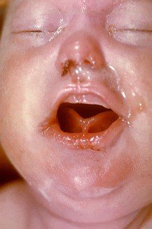lossy-page1-220px-The_face_of_a_newborn_infant_with_Congenital_Syphilis.tif.jpg (혐오주의) 페니실린이 개발되기전 유행했던 공포의 병